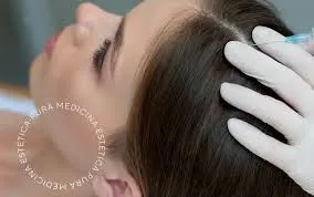 Revitaliza Tu Cabello: Descubre la Carboxiterapia Capilar en Málaga